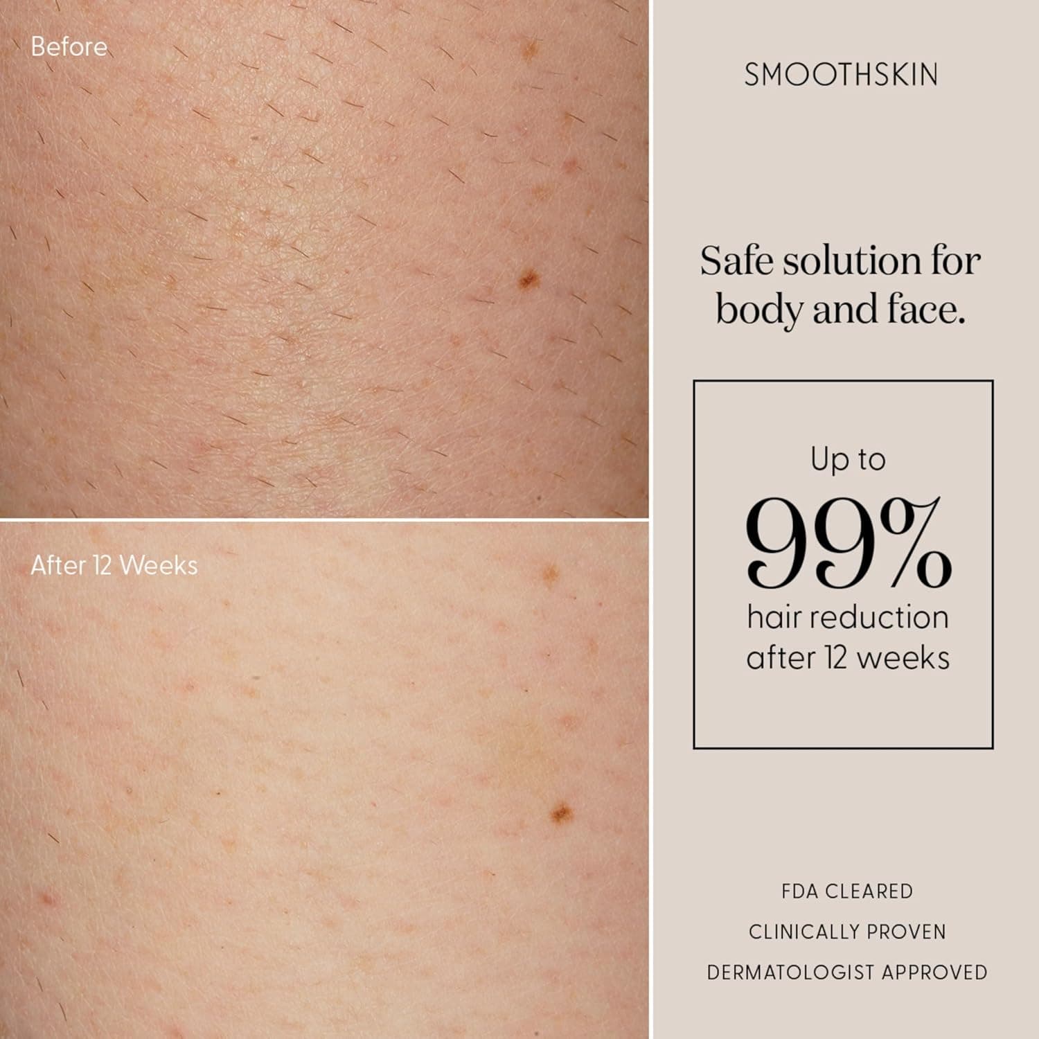 SmoothSkin Pure Fit IPL Hair Removal Device for Home