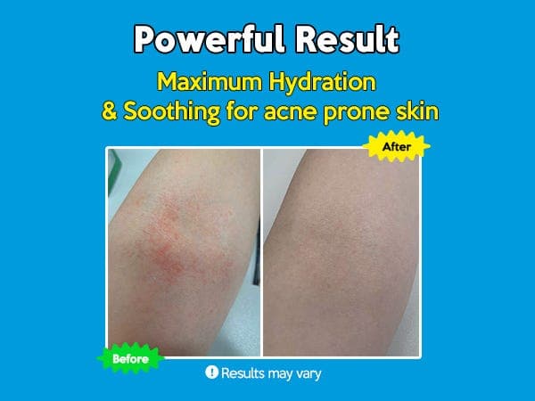 Troubless Hydro Soothing Moisture Cream Acne Prone Skin70ml