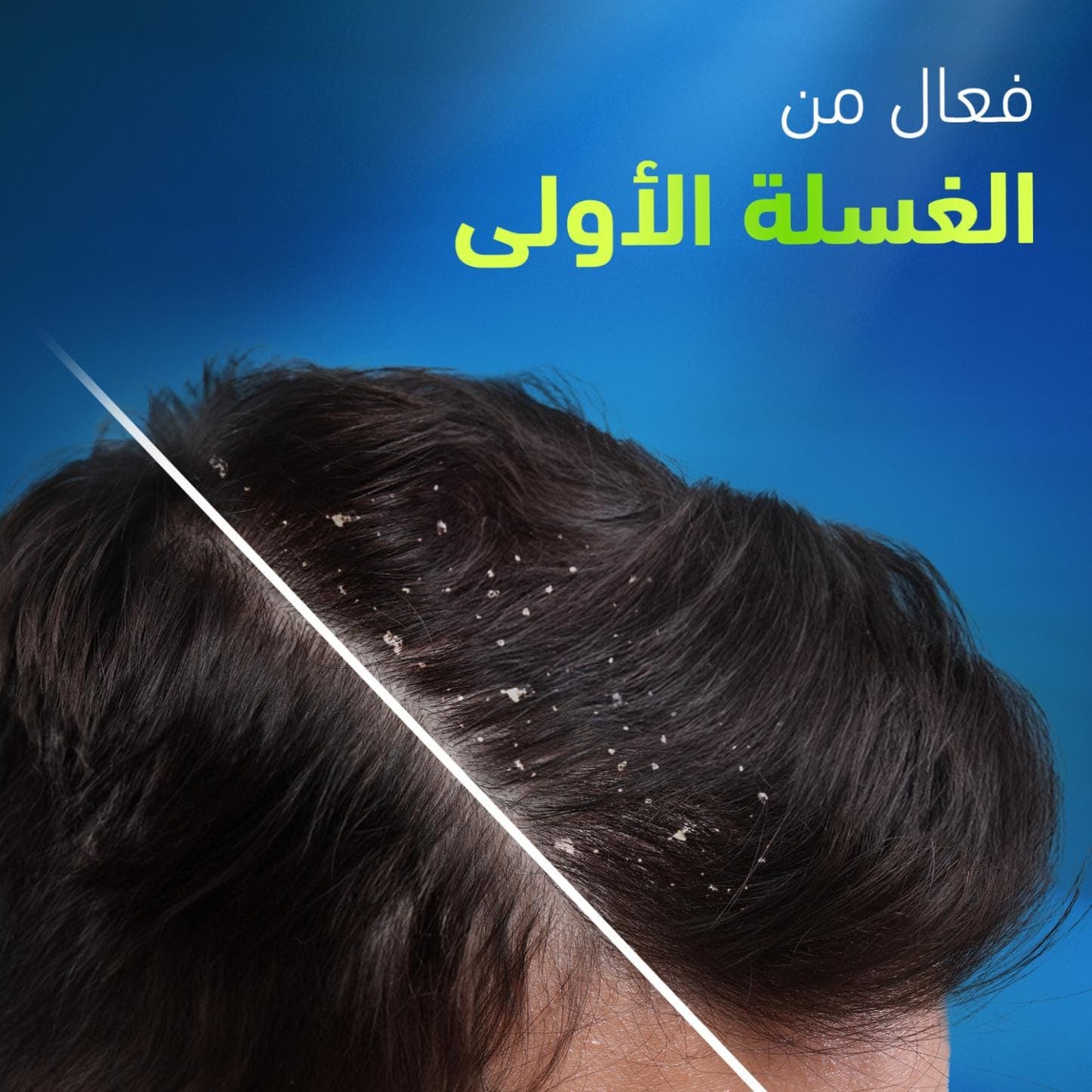 Head & Shoulders Deep Clean Anti-Dandruff Shampoo – Severe Oil Control, Deep Cleansing, 300ml