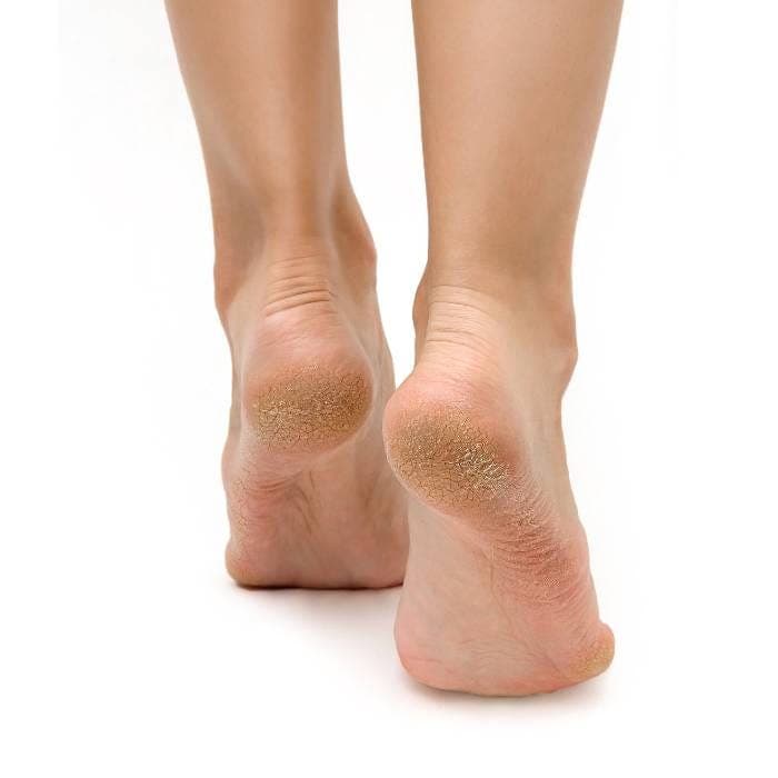 Feetcalm Callus & Hard Skin Spray 20% Urea 75ml.
