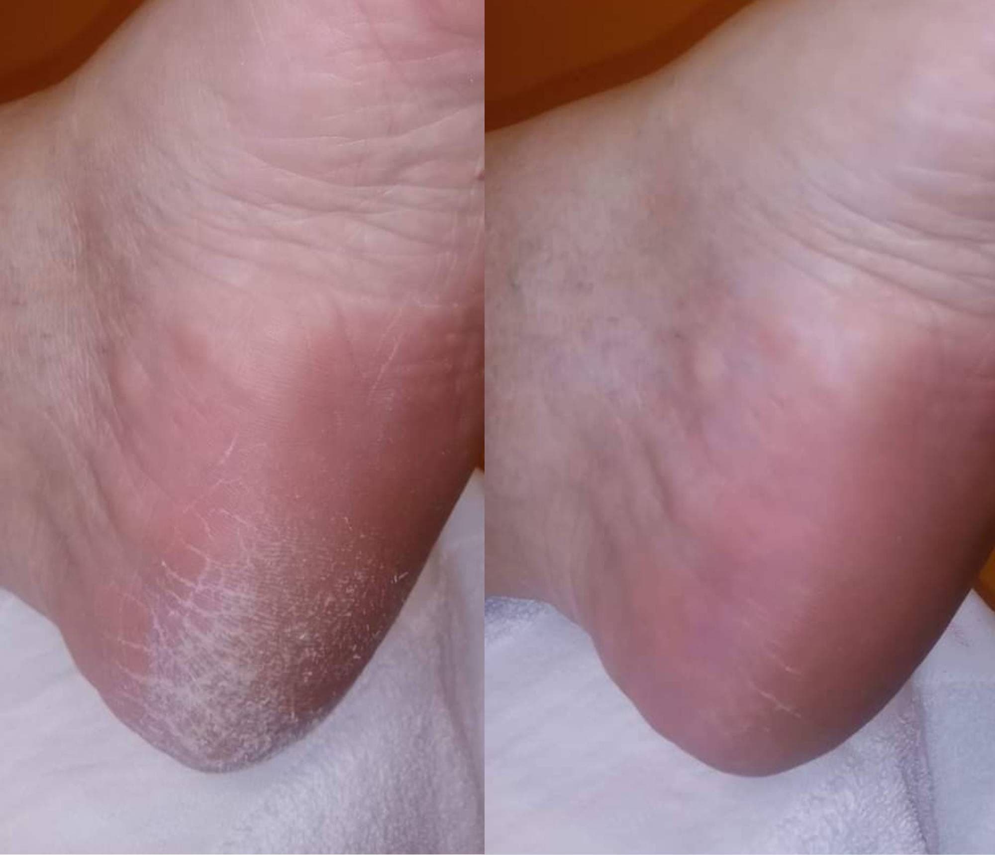 Feetcalm Callus & Hard Skin Spray 20% Urea -125 ml